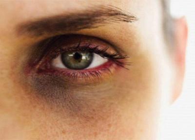 روش های طبیعی برای بهبود حلقه های سیاه دور چشم