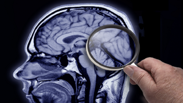 کشفی غیرمنتظره در مغز متوفیان مبتلا به آلزایمر